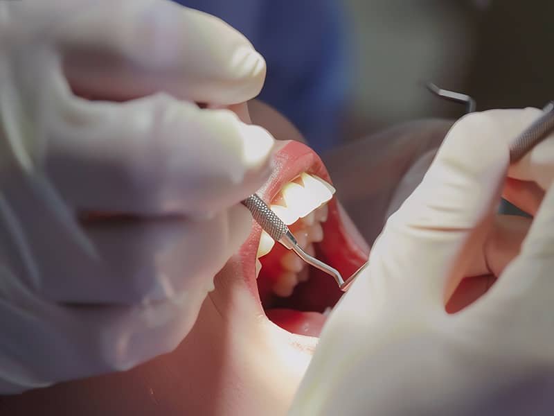 20 Yaş Dişi Çekimi