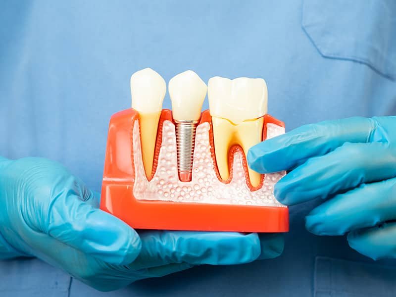 Kemik Grefti (Kemik Tozu)